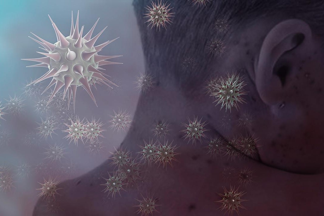 ABŞ-da qızılca epidemiyasına yoluxma sayı sürətlə artır