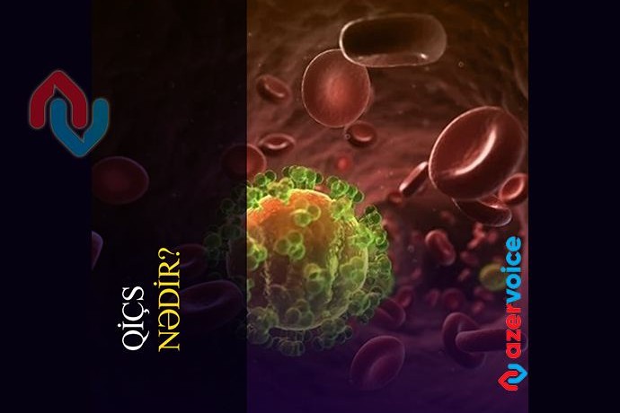 QİÇS -nədir?