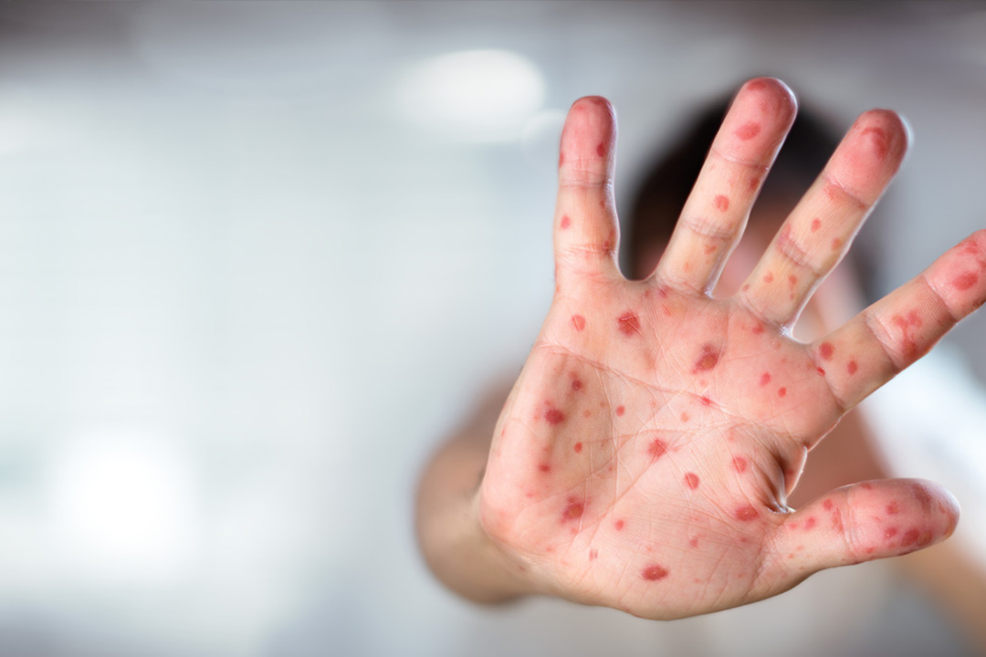 ABŞ-da qızılca epidemiyası 33 ilin ən yüksək göstəricisindədir